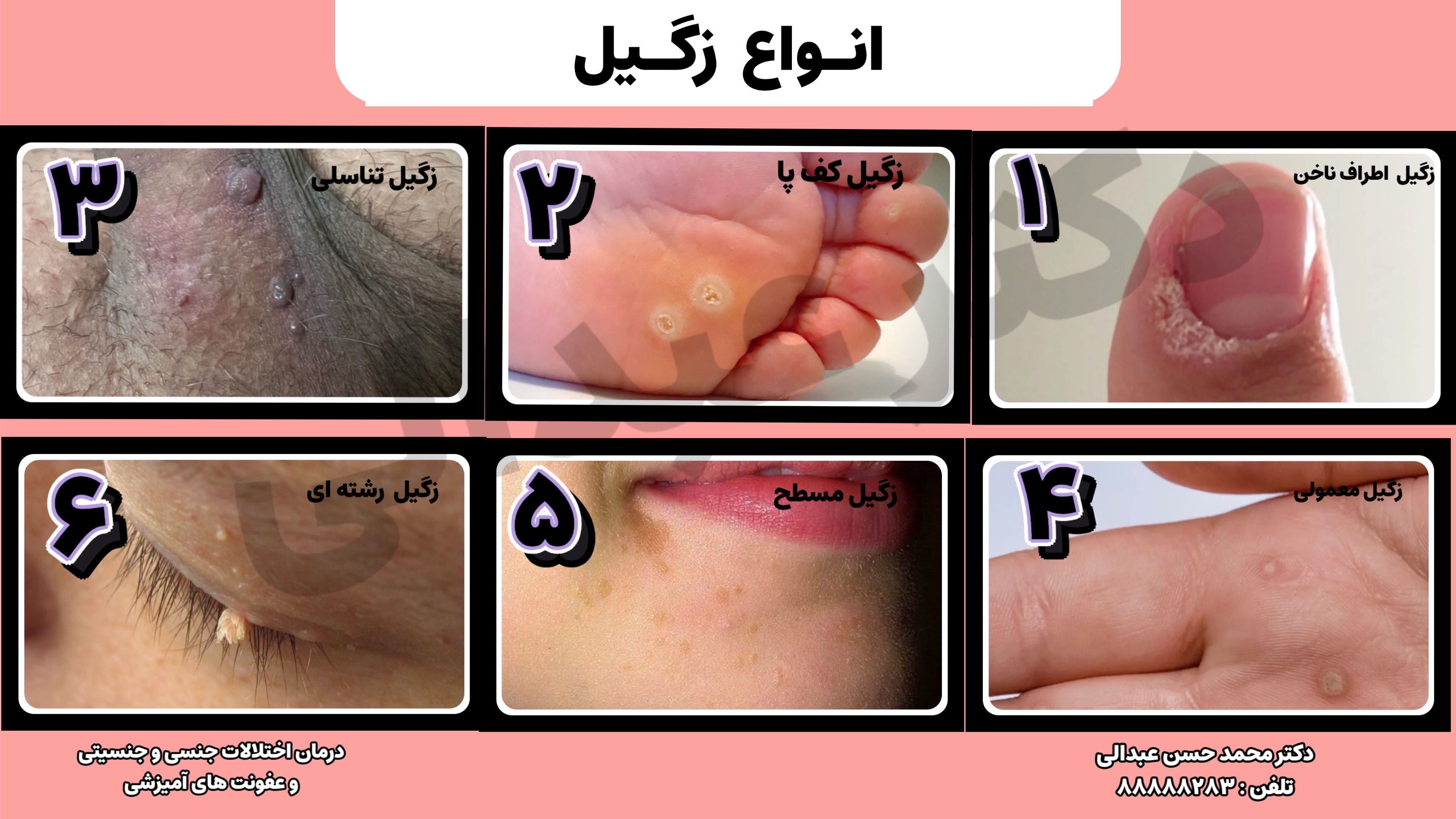 اینفوگرافی انواع زگیل 